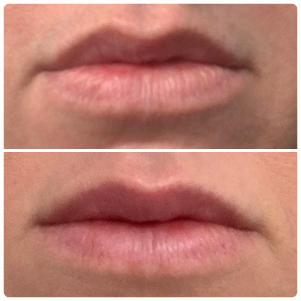 lip flip botox results