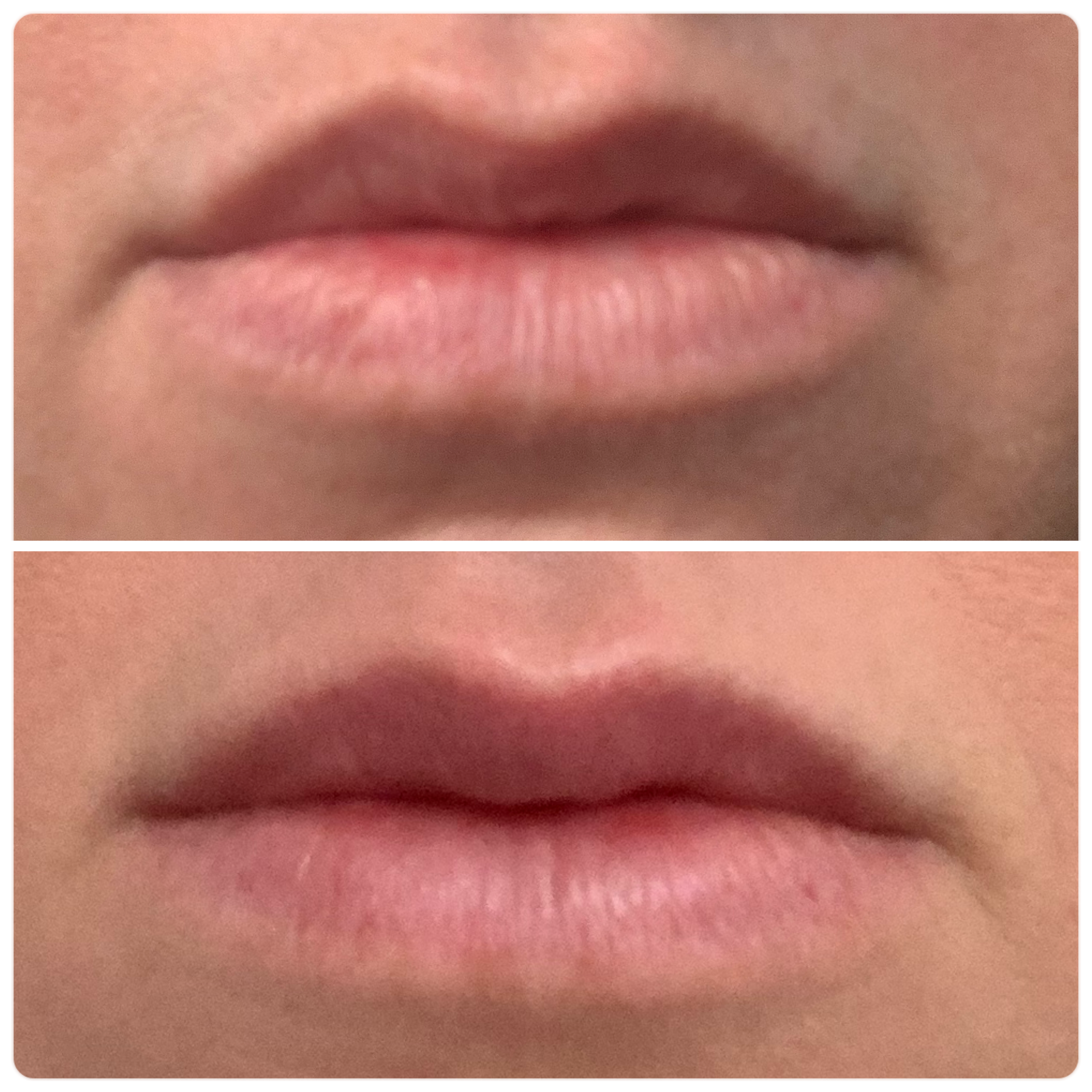 Lip Flip with Botox Results