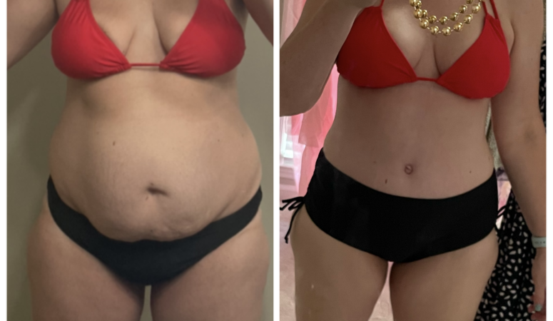 Tummy Tuck plus Breast Lift: 6 Mommy Makeover Mistakes